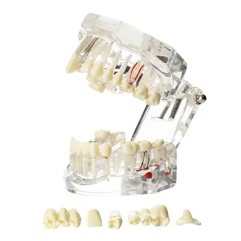 Модель для реставрации имплантатов Dental Typodont Демонстрационная модель для изучения съемных зубов 2001C